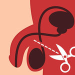 vasectomy