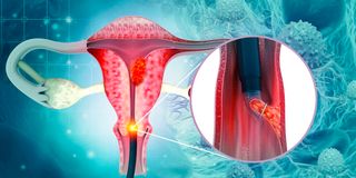 TF260422CervicalCanc(2)