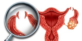 tf2009tuballigation