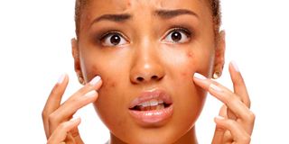 shutterstock_pimples