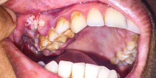 mouth cancer