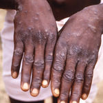 Monkeypox